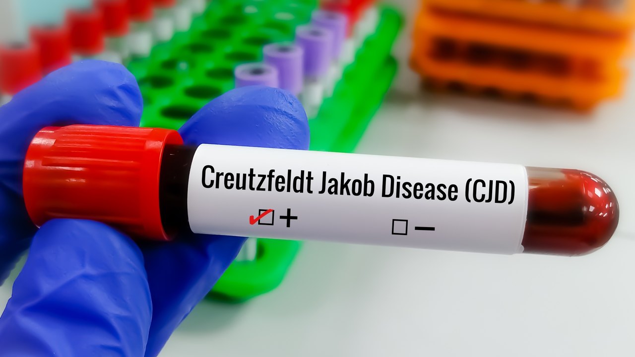 Entenda a Doença de Creutzfeldt-Jakob e a busca por tratamento