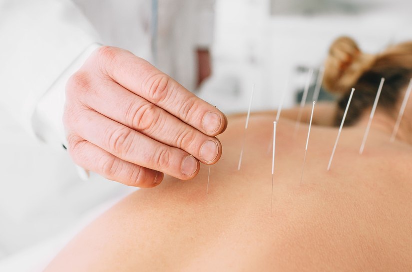 HUPAA- Ufal disponibiliza sessões de acupuntura e promove mais qualidade de vida aos colaboradores