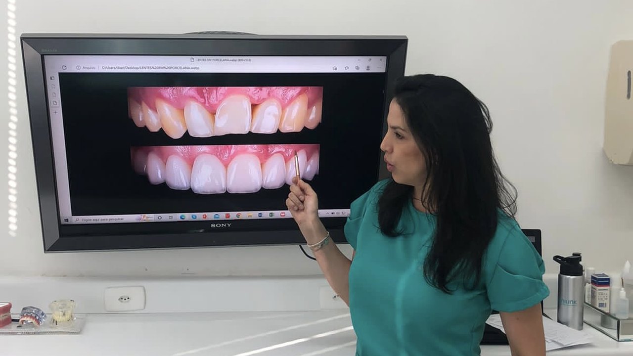 Cirurgiã dentista explica as diferenças entre lentes de resina e de porcelana