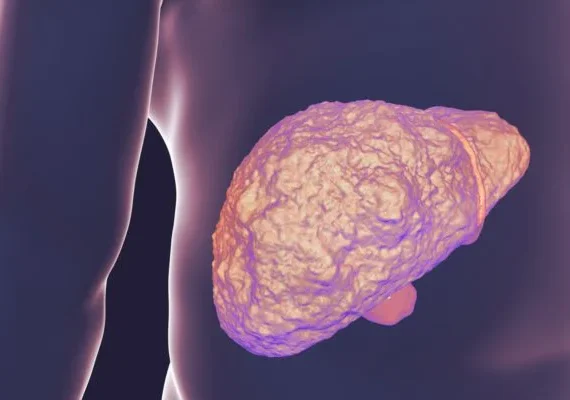 Gordura no fígado aumenta em 30% o risco de desenvolver diabetes