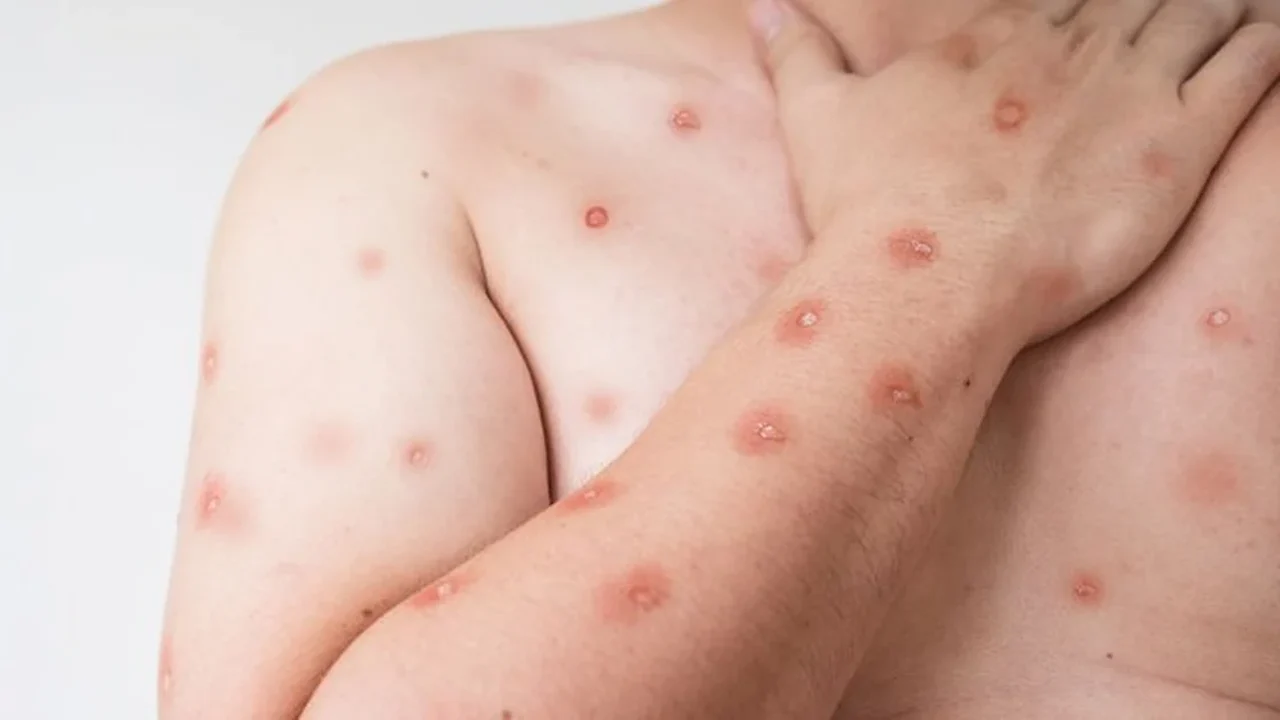 Casos de Mpox sobem no Rio; ex-secretário de saúde faz alerta sobre prevenção