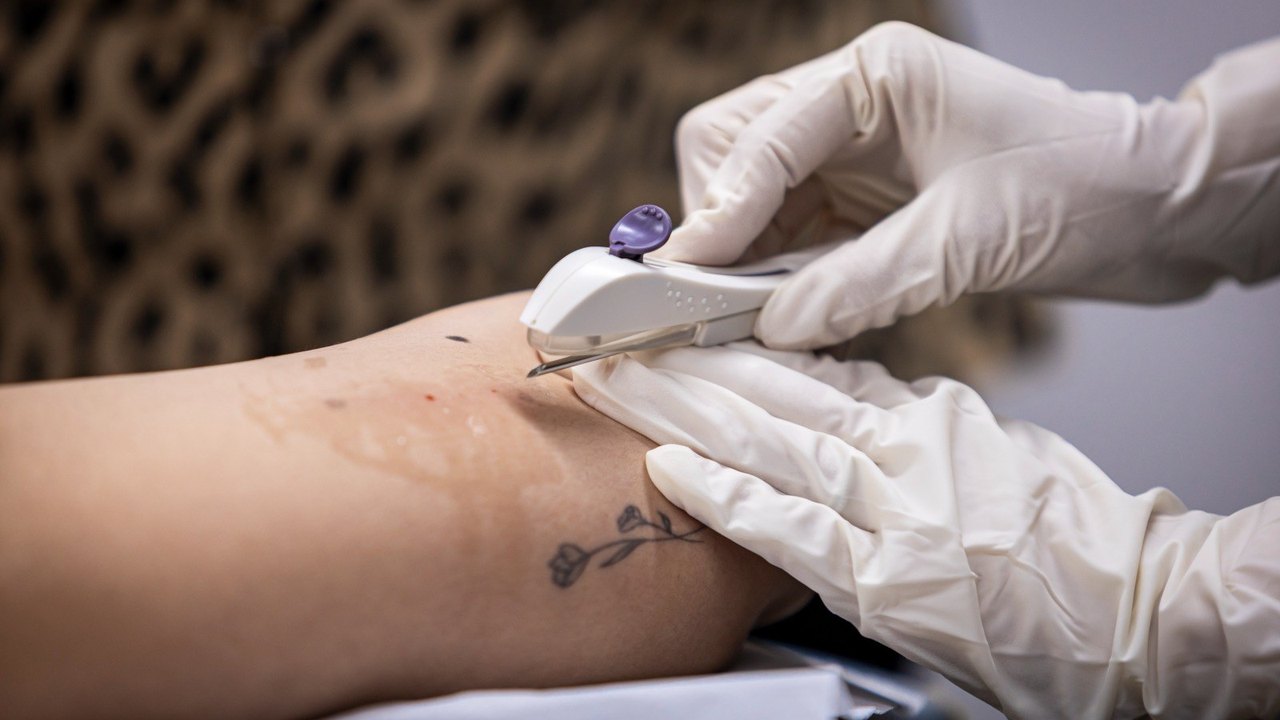 Implanon: Anvisa amplia validade do implante contraceptivo para cinco anos