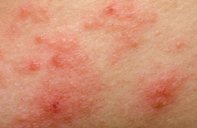 Pinta, mancha ou pequenos ferimentos na pele podem ser indicativos câncer de pele