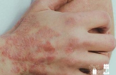 Trabalho alertou sobre surto de sarna associado ao uso de ivermectina