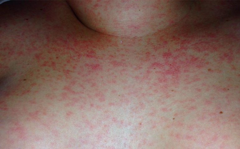 Escarlatina: sintomas, causas e tratamentos; tudo o que você precisa saber sobre a infecção