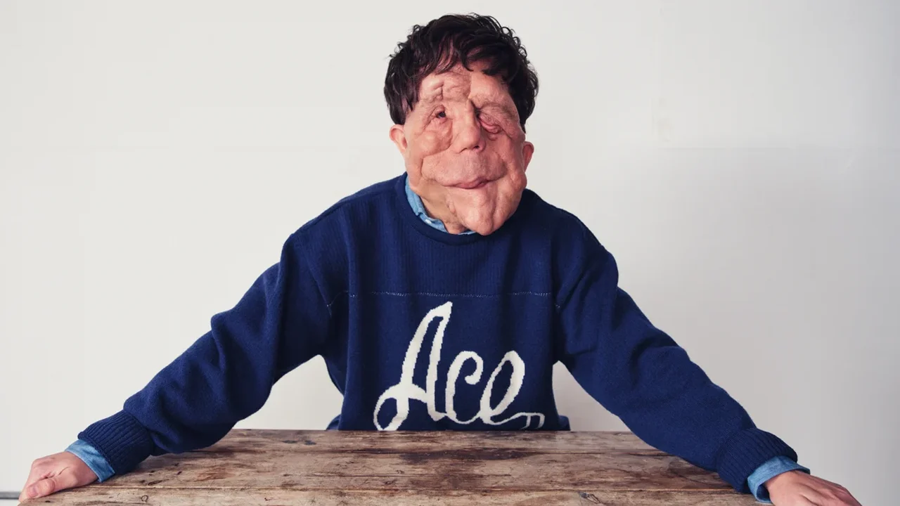 O que é neurofibromatose, condição que afeta o ator Adam Pearson