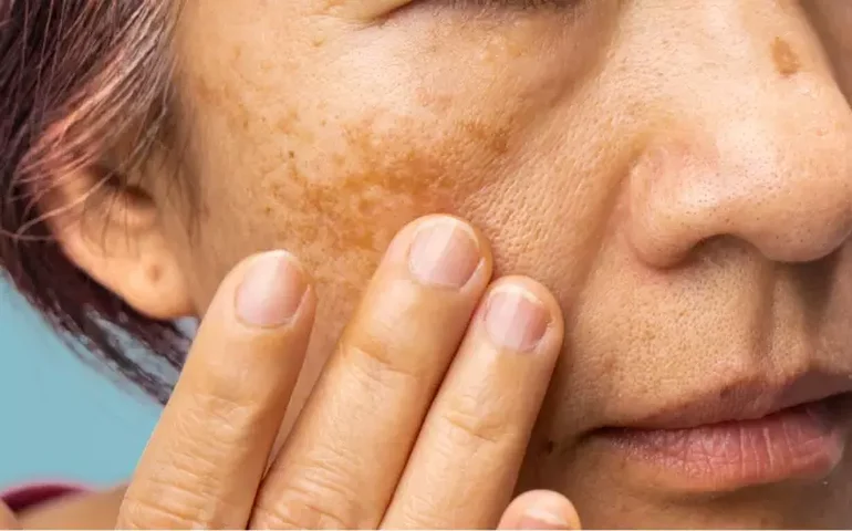 Mulher queima o rosto com produto de 'skin care'; especialista aponta para os riscos do uso indiscriminado de cosméticos