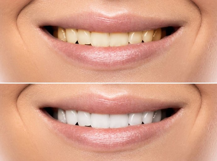 Clareamento dental caseiro sem supervisão profissional pode afetar a saúde bucal