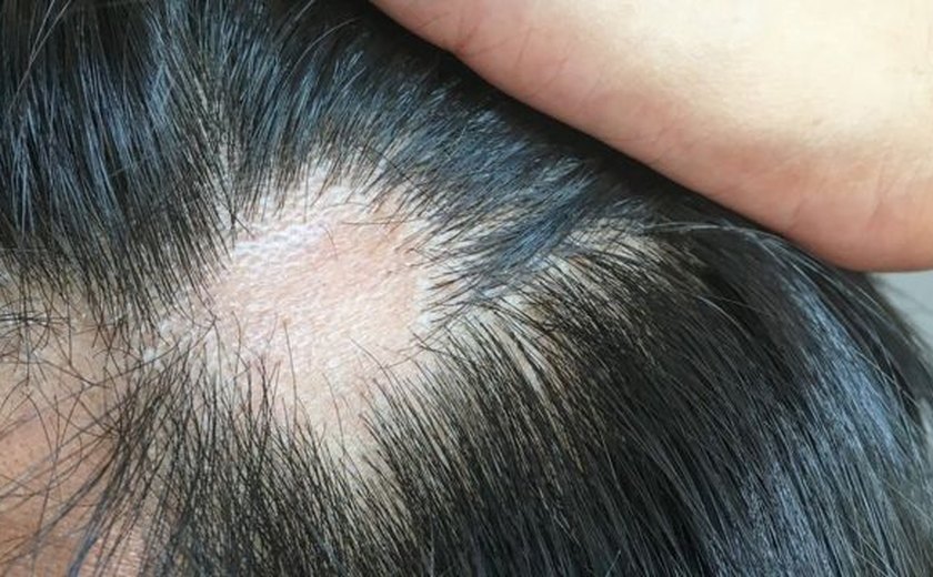 Queda de cabelo: o sintoma inusitado da Covid-19