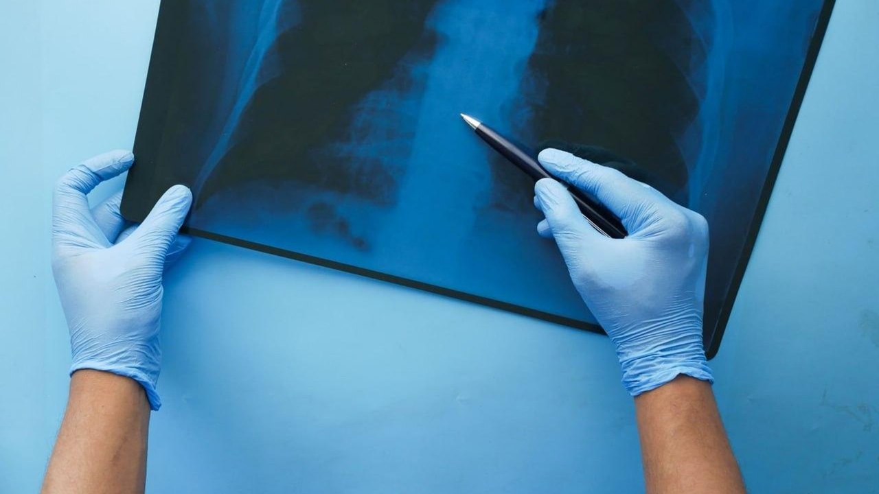 Estudo encontra microplásticos nos pulmões de pacientes com câncer