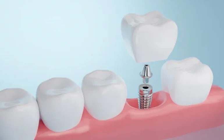 Perdeu um dente? Veja 5 fatores que podem causar perda óssea na boca