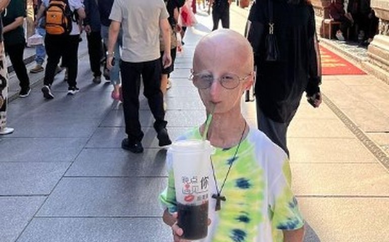 Progeria, a doença do envelhecimento precoce, tem cura? Conheça o quadro