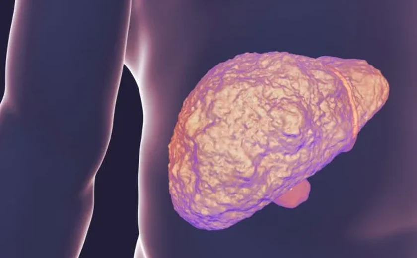 Gordura no fígado aumenta em 30% o risco de desenvolver diabetes