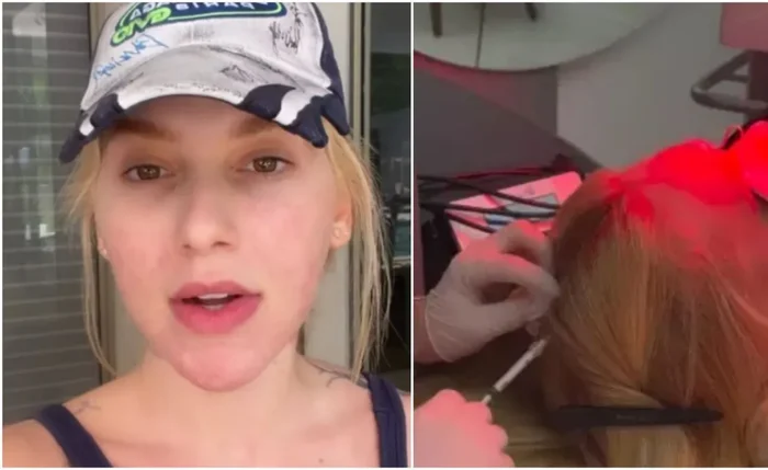 Virginia Fonseca revelou diagnóstico de alopecia areata após notar falha no couro cabeludo