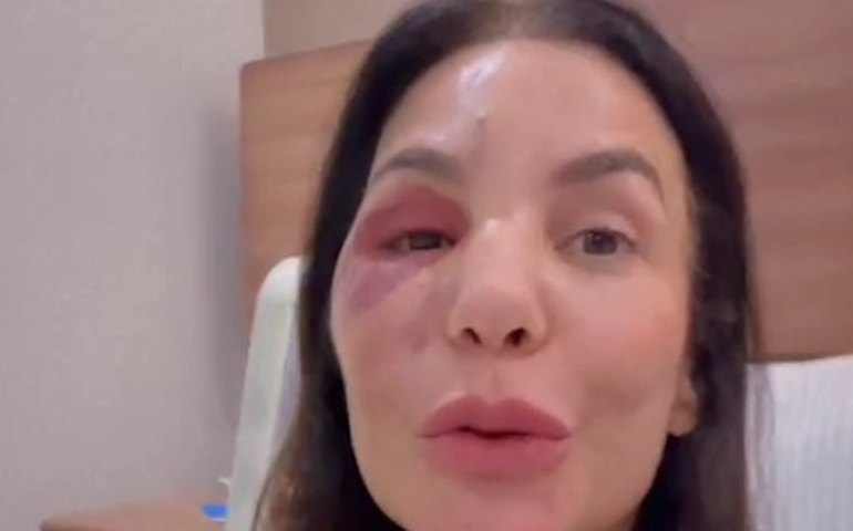 Ivete Sangalo ressurge após cirurgia no rosto: 'Poderia ter sido tão pior'