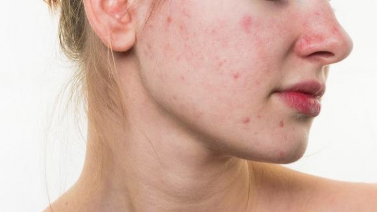 O que fazer em casos de acne? Dermatologista da Sesau explica