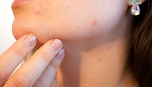 acne-1606765_1280.jpg / Foto: EBC