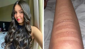 Sergipana sofre queimaduras de segundo grau após adiamento de show da Taylor Swift no Rio de Janeiro