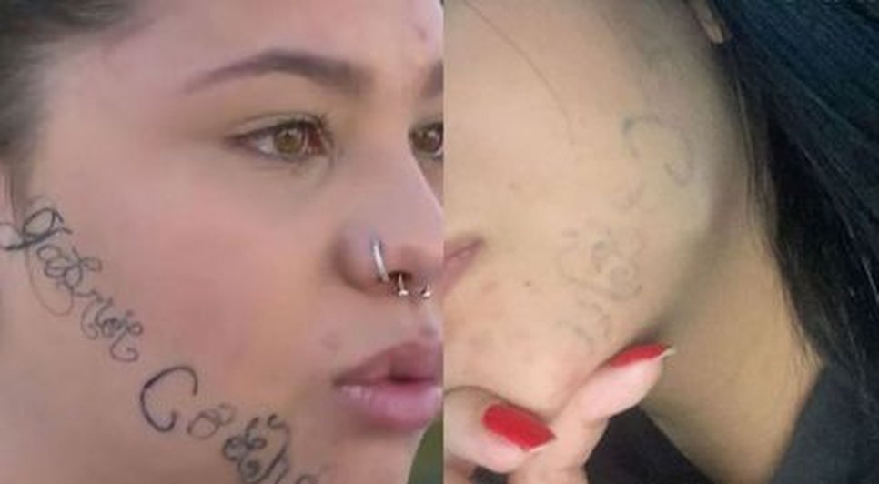 Jovem que teve rosto tatuado à força pelo companheiro mostra antes e depois após sessões de remoção / Foto: Foto: Redes Sociais/ Reprodução