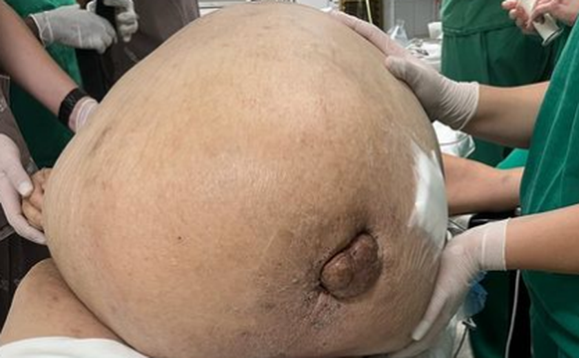 Mulher com tumor de 46kg da barriga é operada no Rio de Janeiro