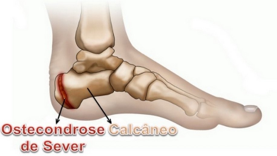 Osteocondrite de Sever