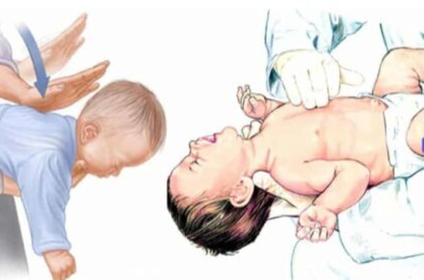 Associação muda técnicas de desengasgo em bebês, crianças e adultos