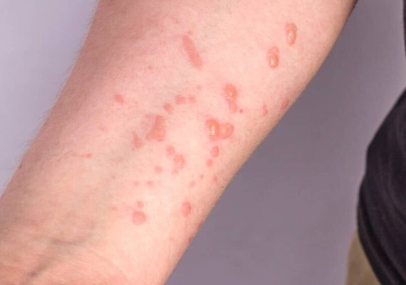 Casos de mpox se aproximam de 100 mil em todo o mundo, alerta OMS