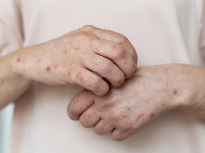 Mpox: veja quais cuidados tomar diante do aumento de casos