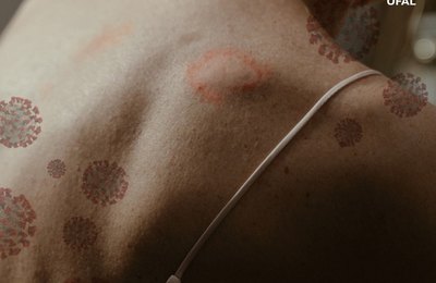 Pandemia de Covid-19 prejudica diagnóstico da hanseníase no País