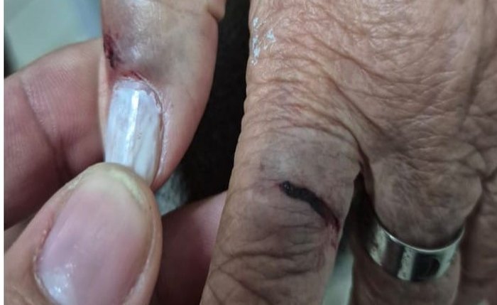 Mãos da idosa mostram marcas da agressão feita por sobrinha e adolescente