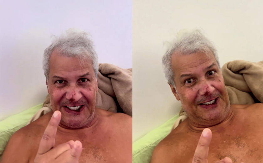 Sikêra Jr. surge com o rosto machucado após alta hospitalar