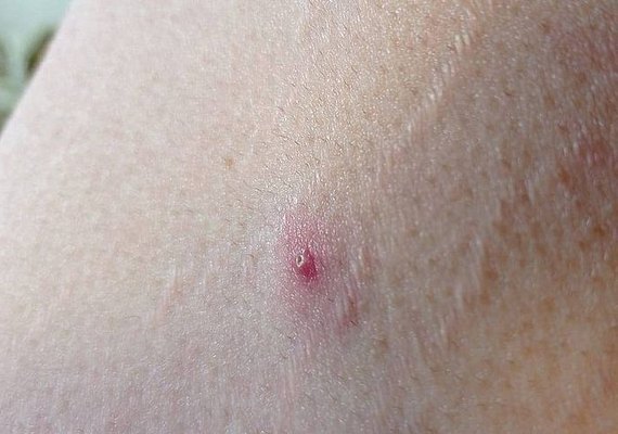 Mundo ultrapassa 100 mil casos de Mpox desde 2022, diz OMS