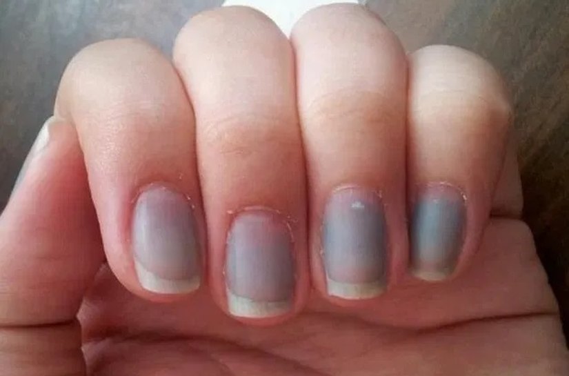 Alterações nas unhas podem indicar doenças graves: Veja os sinais