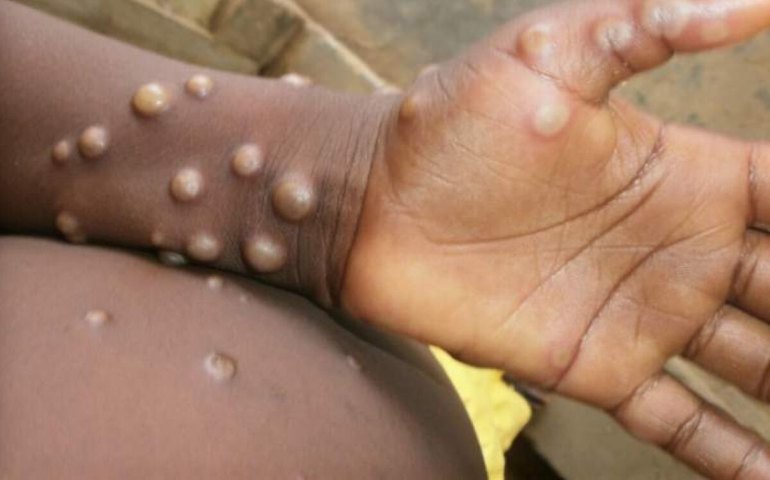 Suécia relata primeiro caso de cepa mortal de mpox fora da África