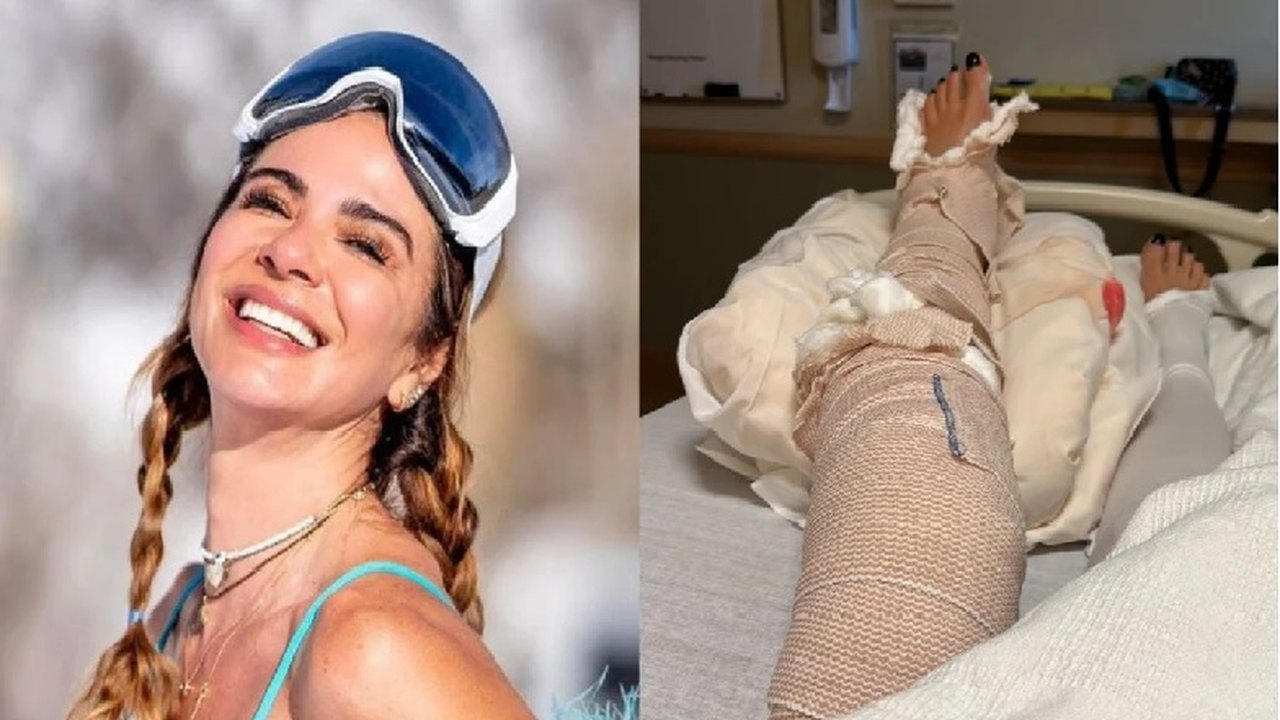Luciana Gimenez revela que quebrou a perna em quatro partes: Muita dor