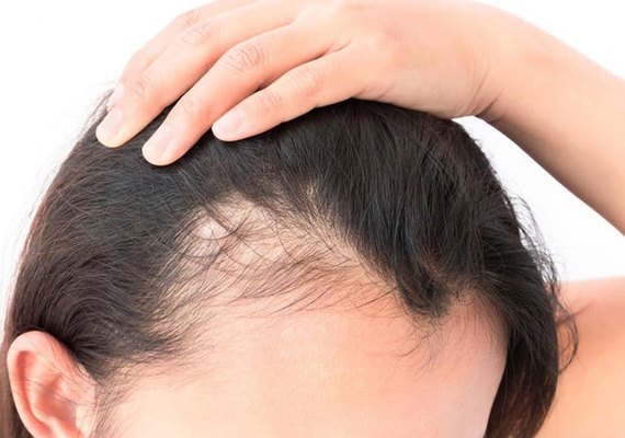 Minoxidil oral é contraindicado pela Anvisa e FDA