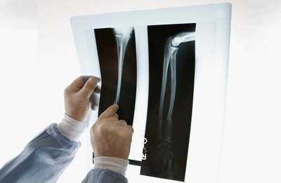 Hospital deve custear tratamento de criança que teve bisturi esquecido dentro do braço