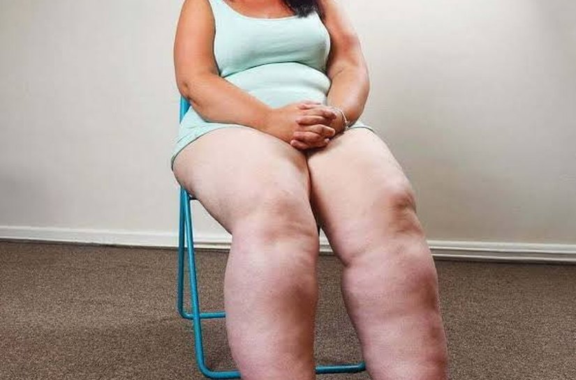 Lipedema não é falta de dieta. É uma doença que ainda demora para ser reconhecida