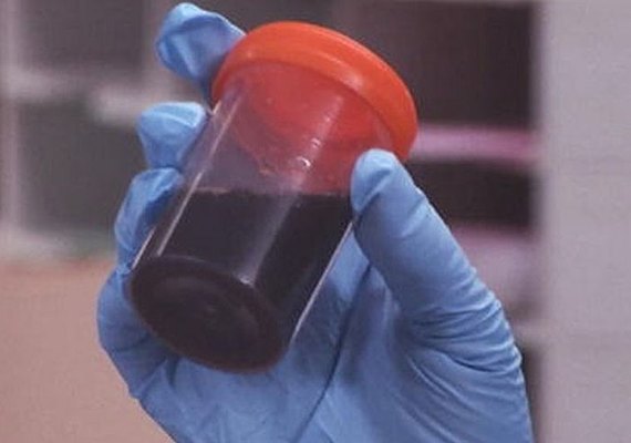 Surto da doença da urina preta gera alerta no Amazonas