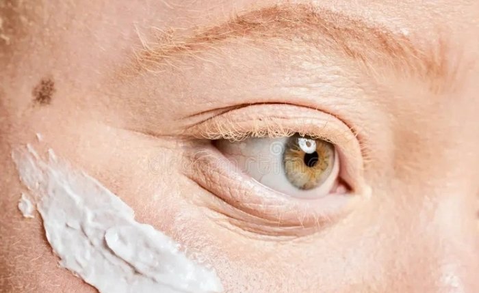 Atualmente, cerca de 25 pessoas com albinismo estão cadastradas no serviço e recebem acompanhamento contínuo