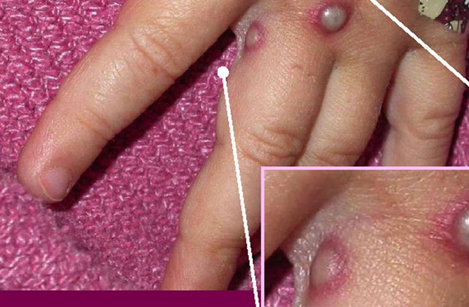Lesões na pele podem durar até quatro semanas / Foto: Foto: CDC/Divulgação
