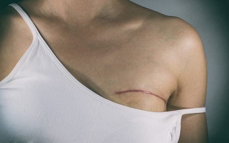 Nova lei garante fisioterapia no SUS a pacientes que retirarem mama