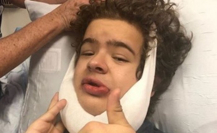 Ator extraiu 14 dentes de uma só vez para tratar síndrome rara