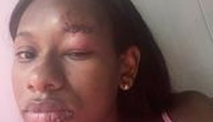 Estudante é acusada injustamente e agredida com mordidas no rosto em Carmópolis