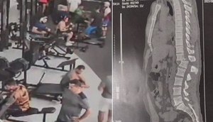 Aluno atingido por aparelho de musculação em academia tem 1% de chance de voltar a andar