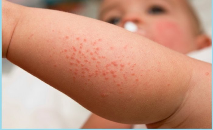 Gravidade da Meningite Meningocócica reforça a importância da vacinação Gravidade da Meningite Meningocócica reforça a importância da vacinação