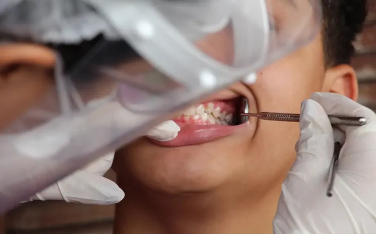 O que é a brancorexia, novo distúrbio da obsessão dos dentes claros