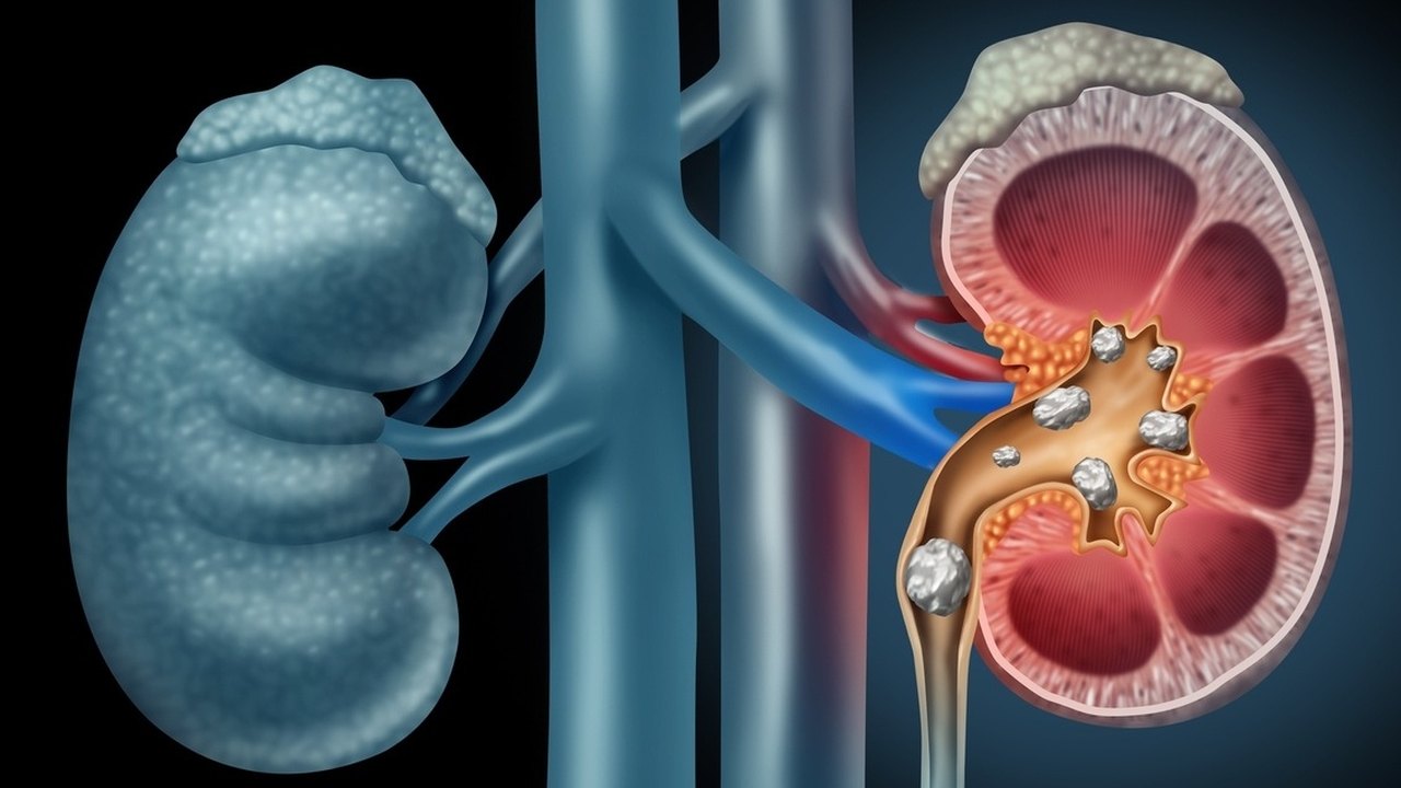 Danos aos rins? Cálculos renais? Entenda efeitos das bebidas com gás no seu corpo