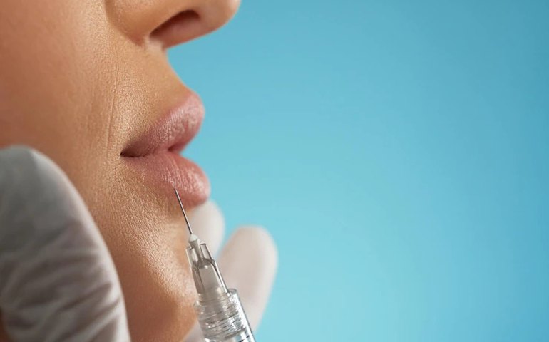 Reação alérgica de americana chama a atenção para preenchimento labial