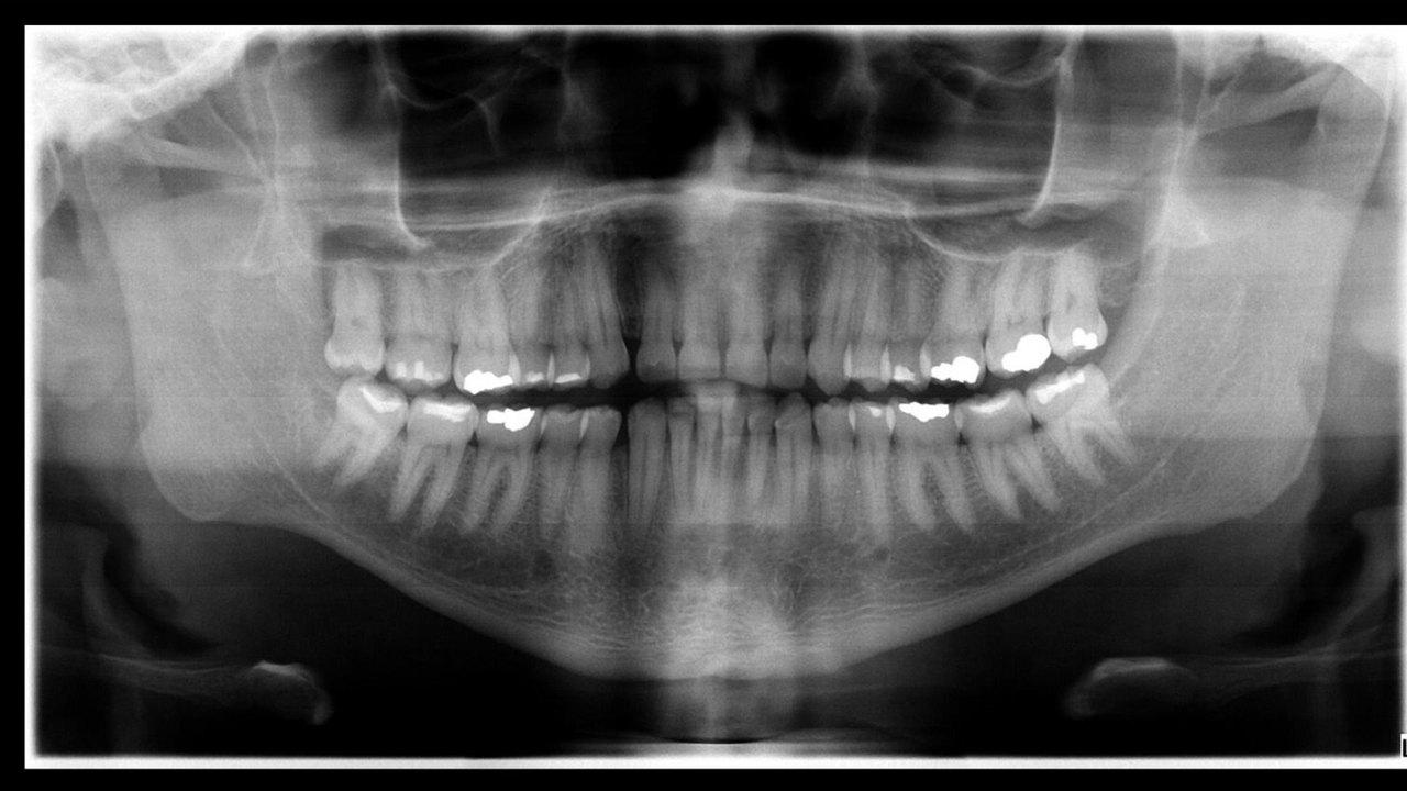 Corpo de enfermeiro do Mato Grosso é identificado após exame de odontologia legal